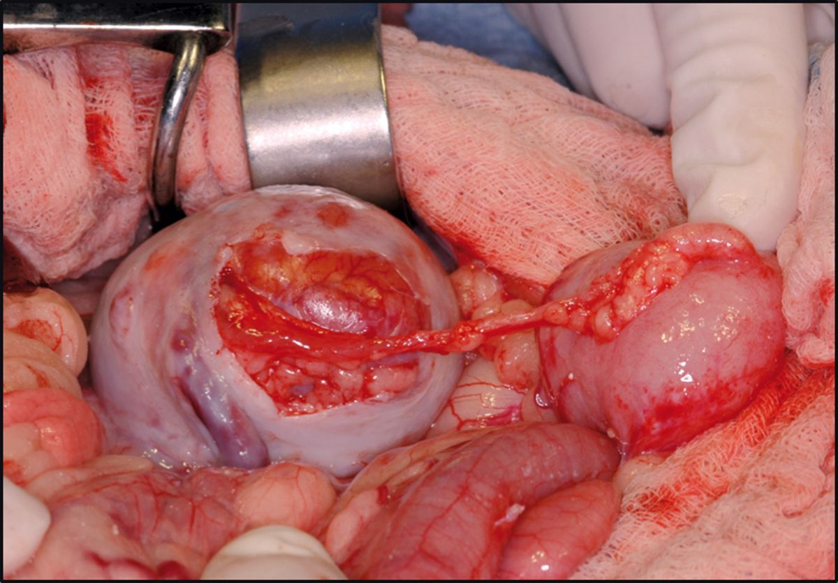 Retroperitoneale Fibrose. Die chirurgische Dissektion und Teilresektion des das Allotransplantat umgebenden fibrotischen Gewebes, sorgt für eine Aufhebung der Harnleiterobstruktion.