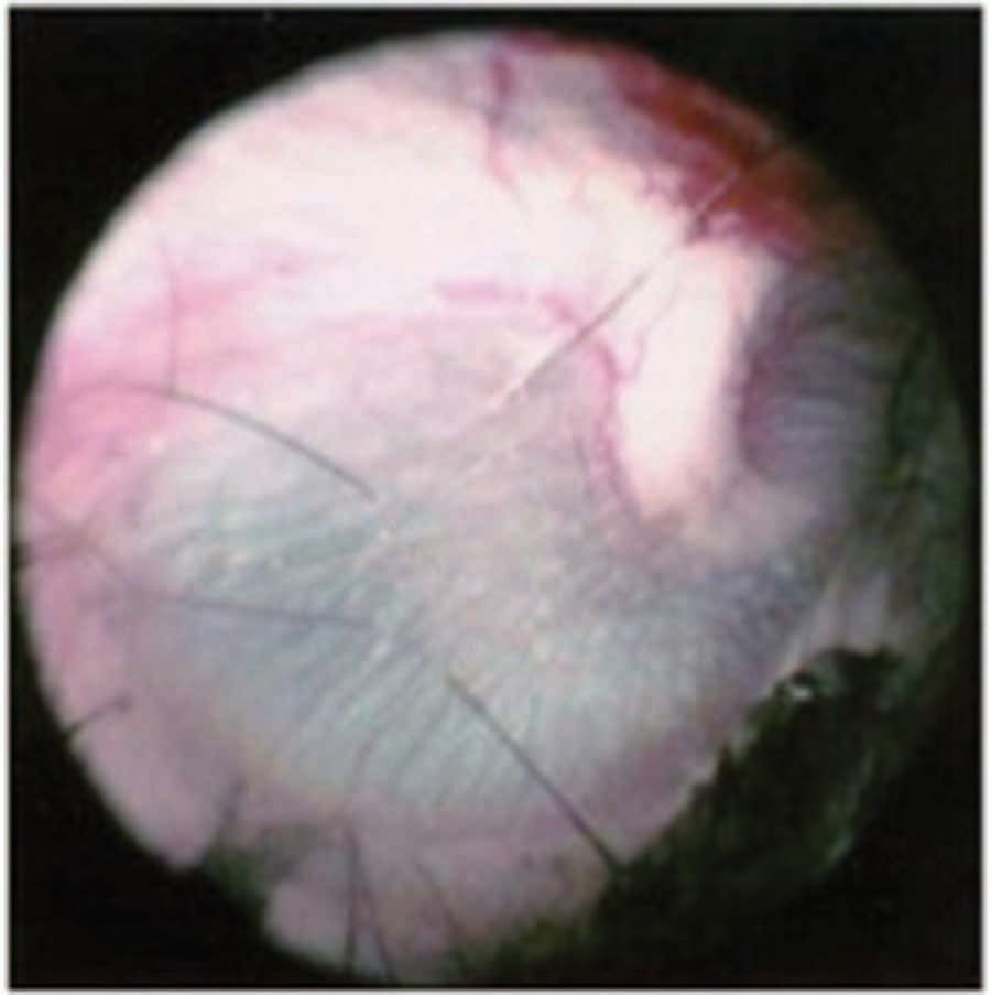 Figure 3. Image vido-otoscopique de la membrane tympanique normale