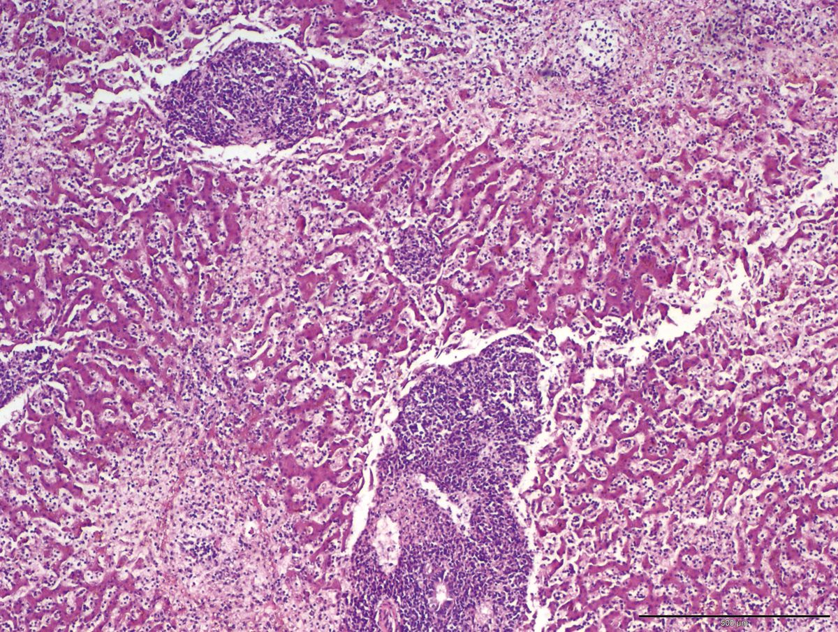 Histopathologie de tissu hépatique avec une coloration H&E, montrant des agrégats denses de cellules rondes monomorphiques qui envahissent les voies portales et les zones centrolobulaires, circulant dans les sinusoïdes et interrompant les cordes hépatiques. Ceci est compatible avec un lymphome.