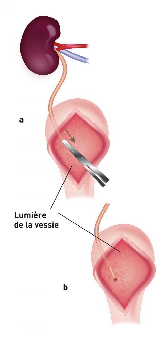 Schéma montrant l'urétéronéocystostomie en utilisant une technique d'apposition de la muqueuse intravésiculaire. Une cystotomie ventrale est effectuée sur la ligne médiane et l'uretère du donneur est amené directement à l’apex de la vessie (a, b).