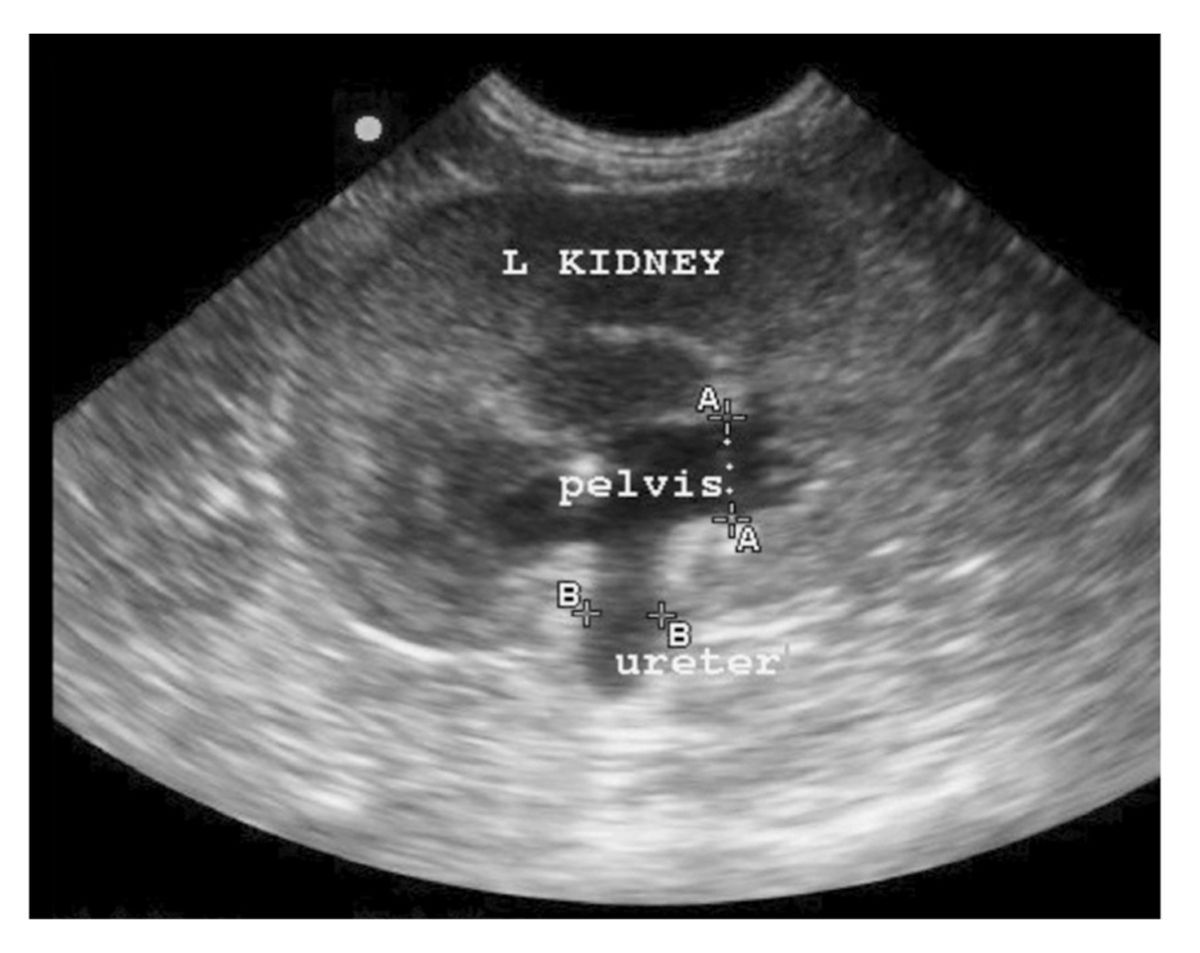 Dilation of the renal pelvis is usually obvious on ultrasound scan; the pelvis diameter should be measured to assess the degree of pyelectasia.