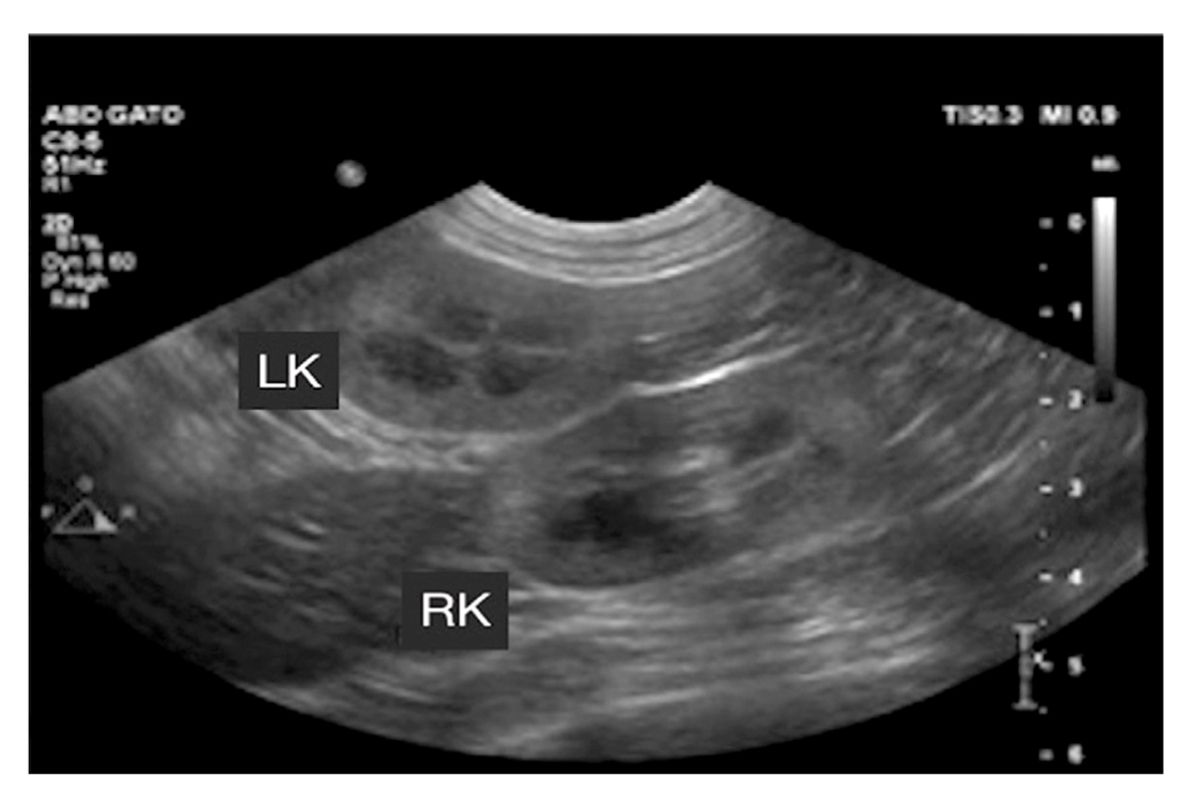 Scansione SR in decubito laterale destro che mostra entrambi i reni. Bisogna prestare attenzione a identificare il rene sinistro dal destro (LK: rene sinistro; RK: rene destro) quando è giustificata un'identificazione accurata, ma questo è spesso inutile quando si esegue successivamente un imaging più avanzato.