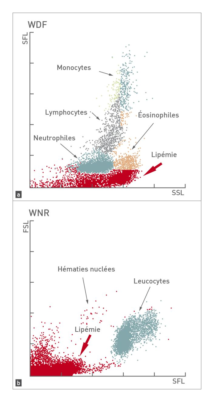 Deux cytogrammes montrant l’interférence de la lipémie dans une analyse de leucocytes