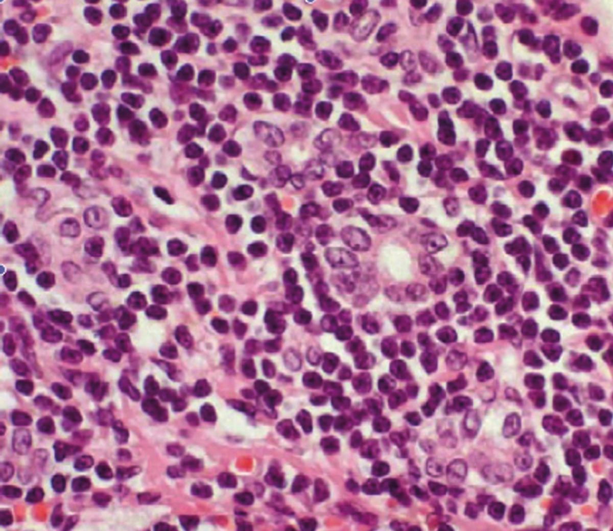 Histopathology of a cat’s liver with lymphocytic cholangitis. Note the marked infiltration of small lymphocytes in the portal area and concurrent biliary proliferation.