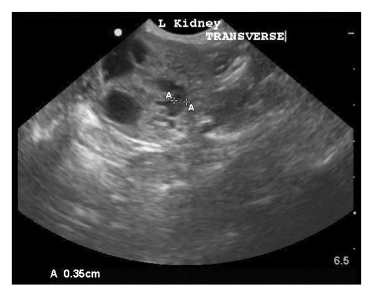 Polycystic kidney disease is a genetic disorder commonly seen in Persian cats; multiple cysts form within the kidneys and are readily detected on sonography.
