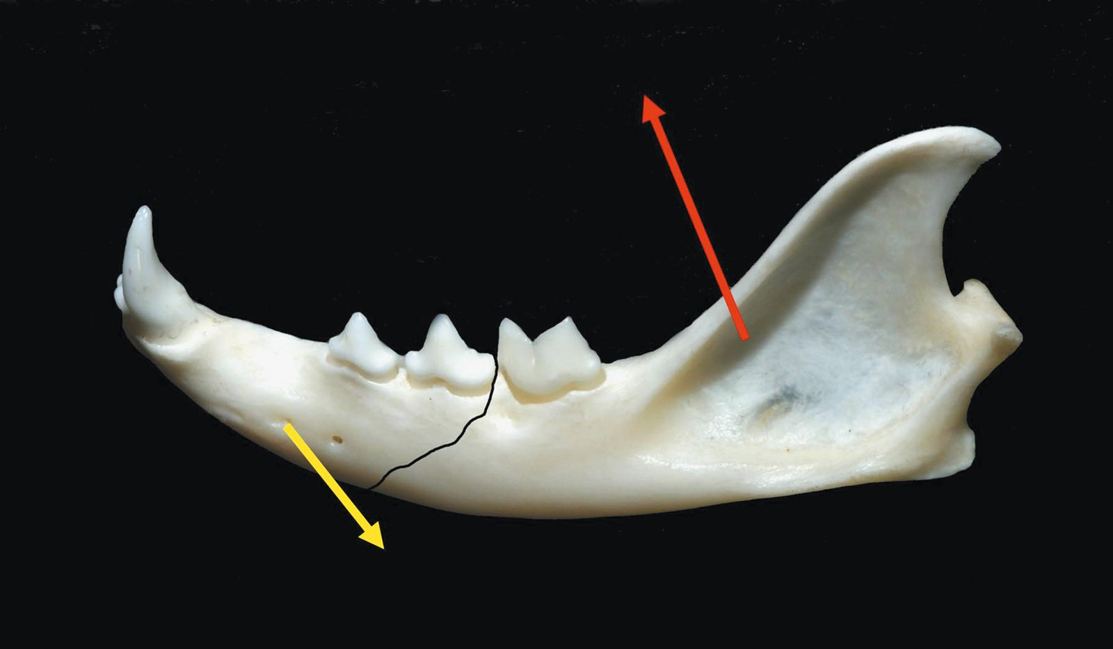 Figure 3. Fracture du corps de la mandibule ; la flèche jaune indique 