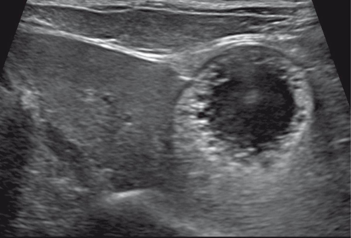 Transverse ultrasound image of a feline gallbladder demonstrating thickened wall with a palisading appearance, consistent with cholangitis.