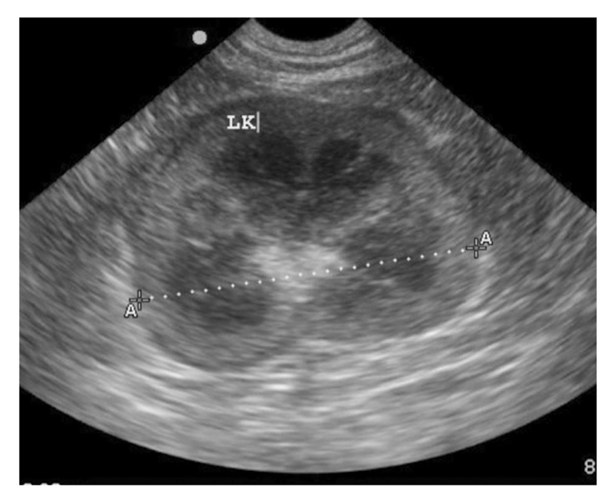 An enlarged kidney, measuring 6.26 cm in length – normal is less than 4.5 cm. Nephromegaly can be due to many different factors, including infection, obstruction, loss of function in the contralateral kidney, and infiltrative disease such as lymphoma.