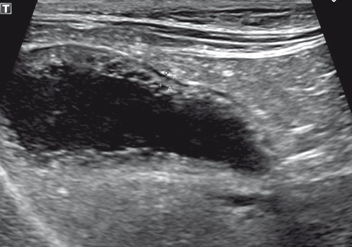 A longitudinal sonographic image of a feline gallbladder where “calipers” are measuring wall thickness at 1.9 mm. This image also demonstrates the “palisading” like material “growing” off the inner wall into the lumen of the gallbladder.