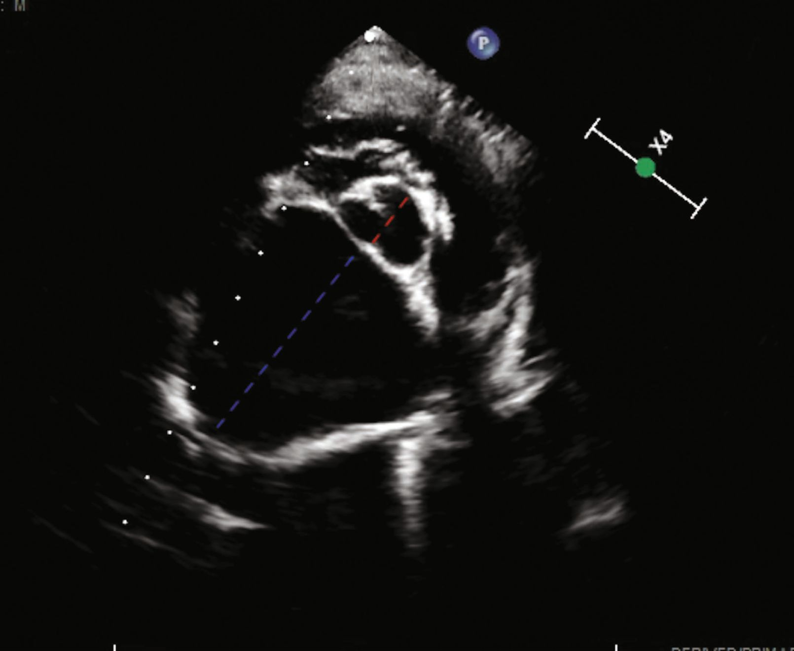 Échographie « point of care » (POCUS) 
