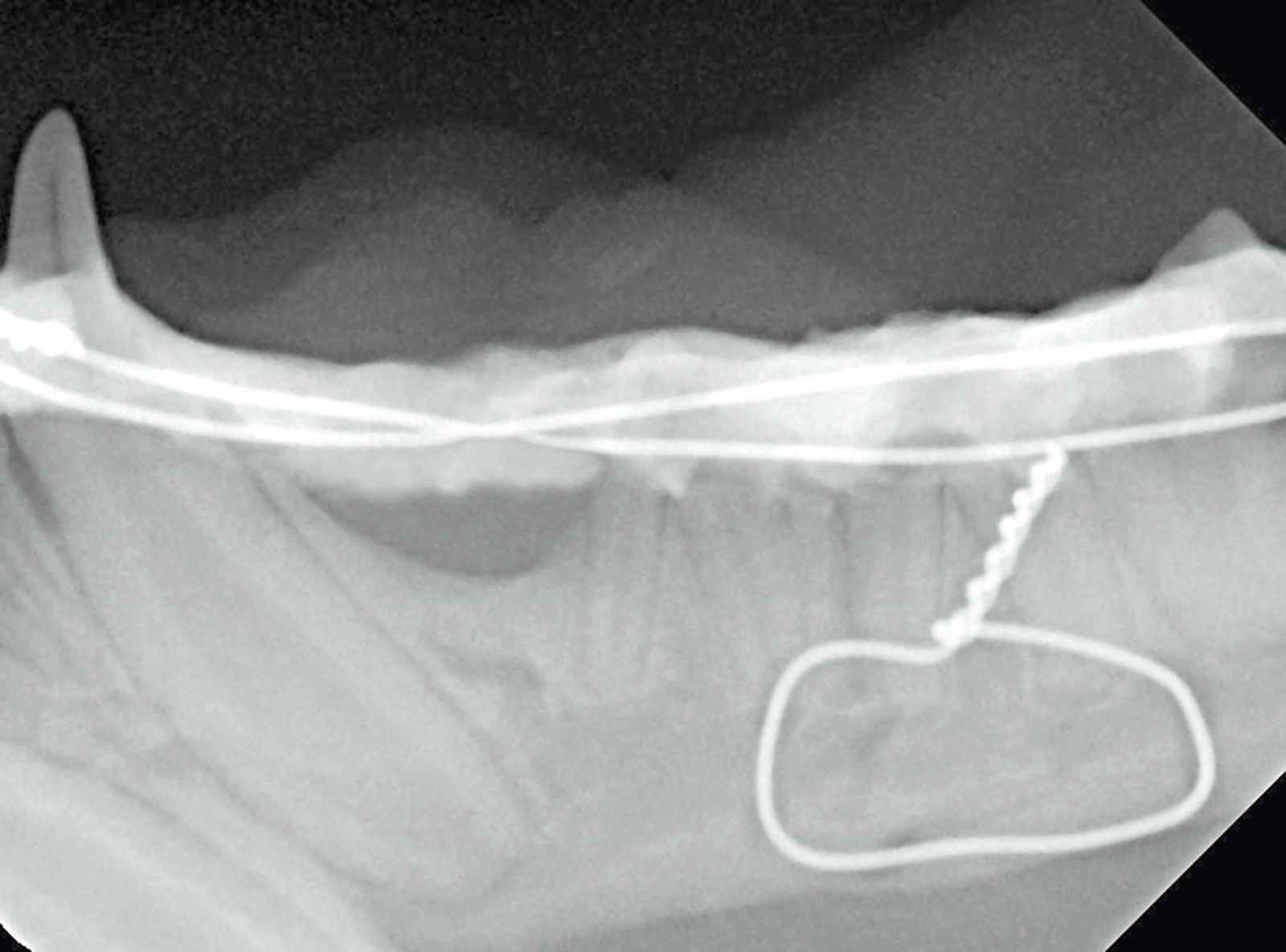 Figure 4. Fracture de la mandibule avec dplacement :d