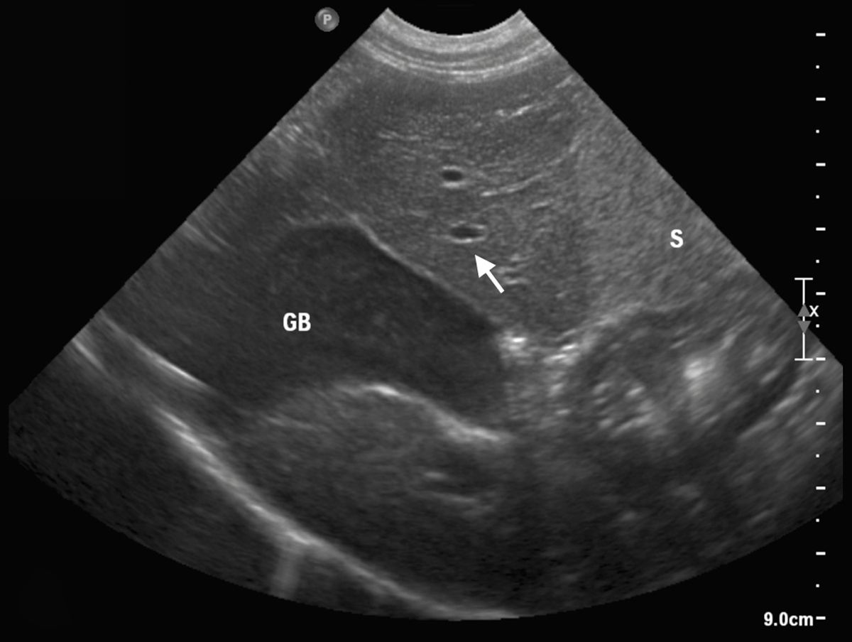 Ultraschall der normalen Leber eines Hundes. Transversalebene mit Gallenblase (GB) rechts; Die Portalgefäße (weißer Pfeil) haben hyperechogene Wände.
