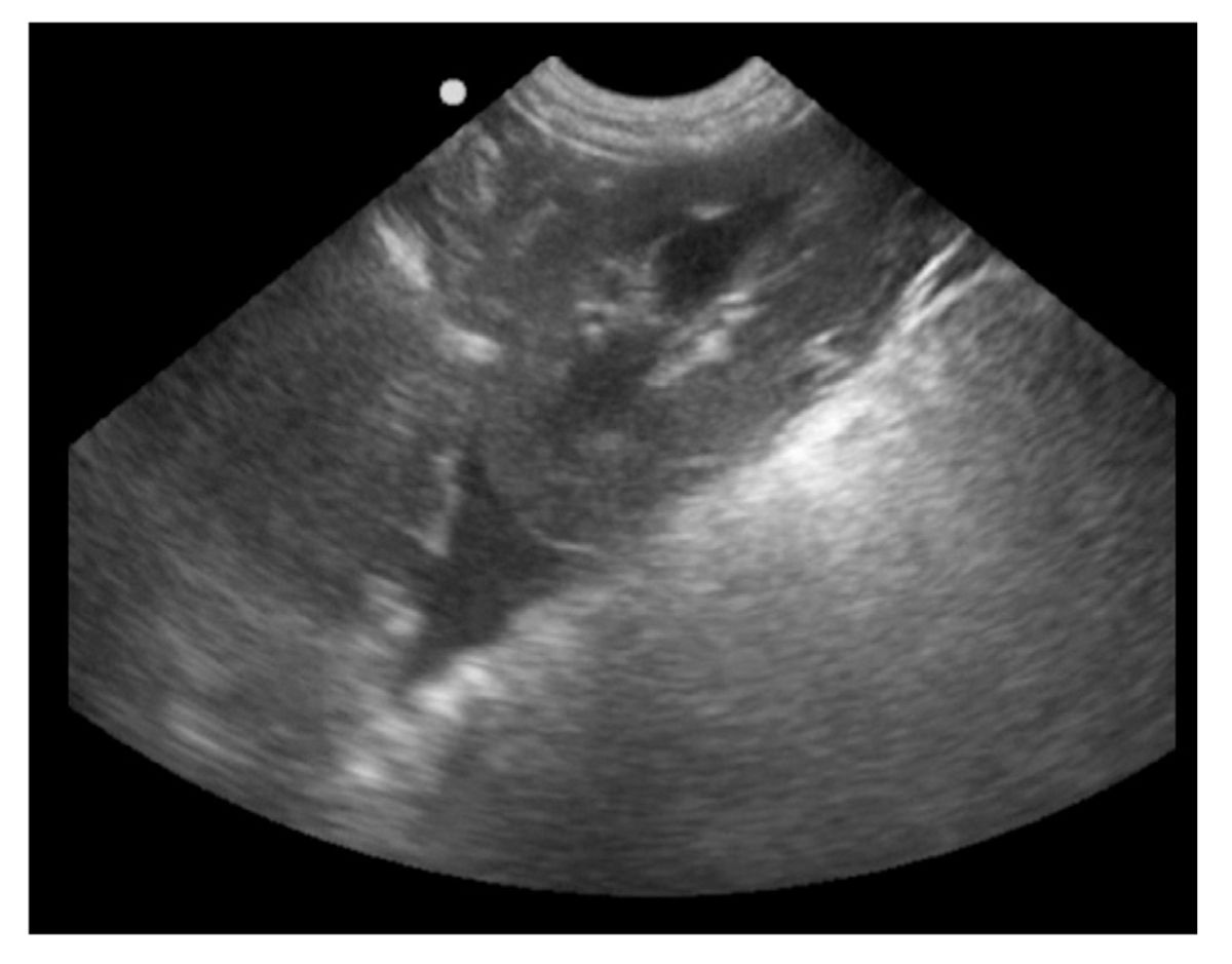 Freie Flüssigkeit in der Peritonealhöhle erscheint im Sonogramm in der Regel als dreieckige Struktur, da sich die Flüssigkeit außerhalb der Nierenkapsel befindet.