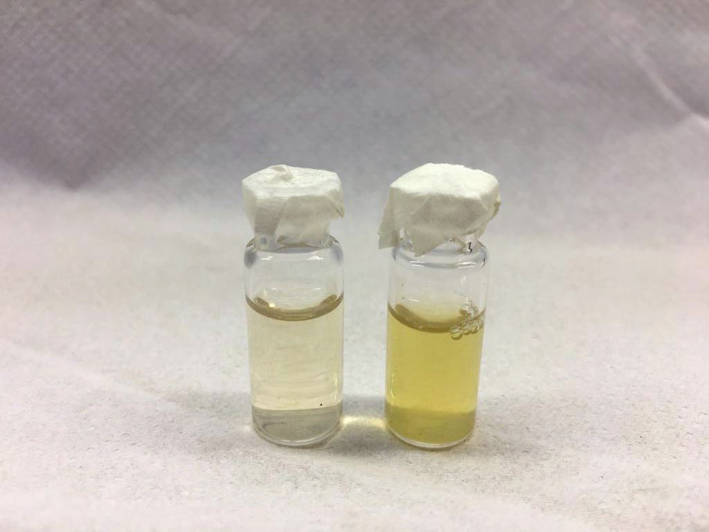 Normal amniotic (transparent) and allantoic (yellow) fluids obtained by centesis