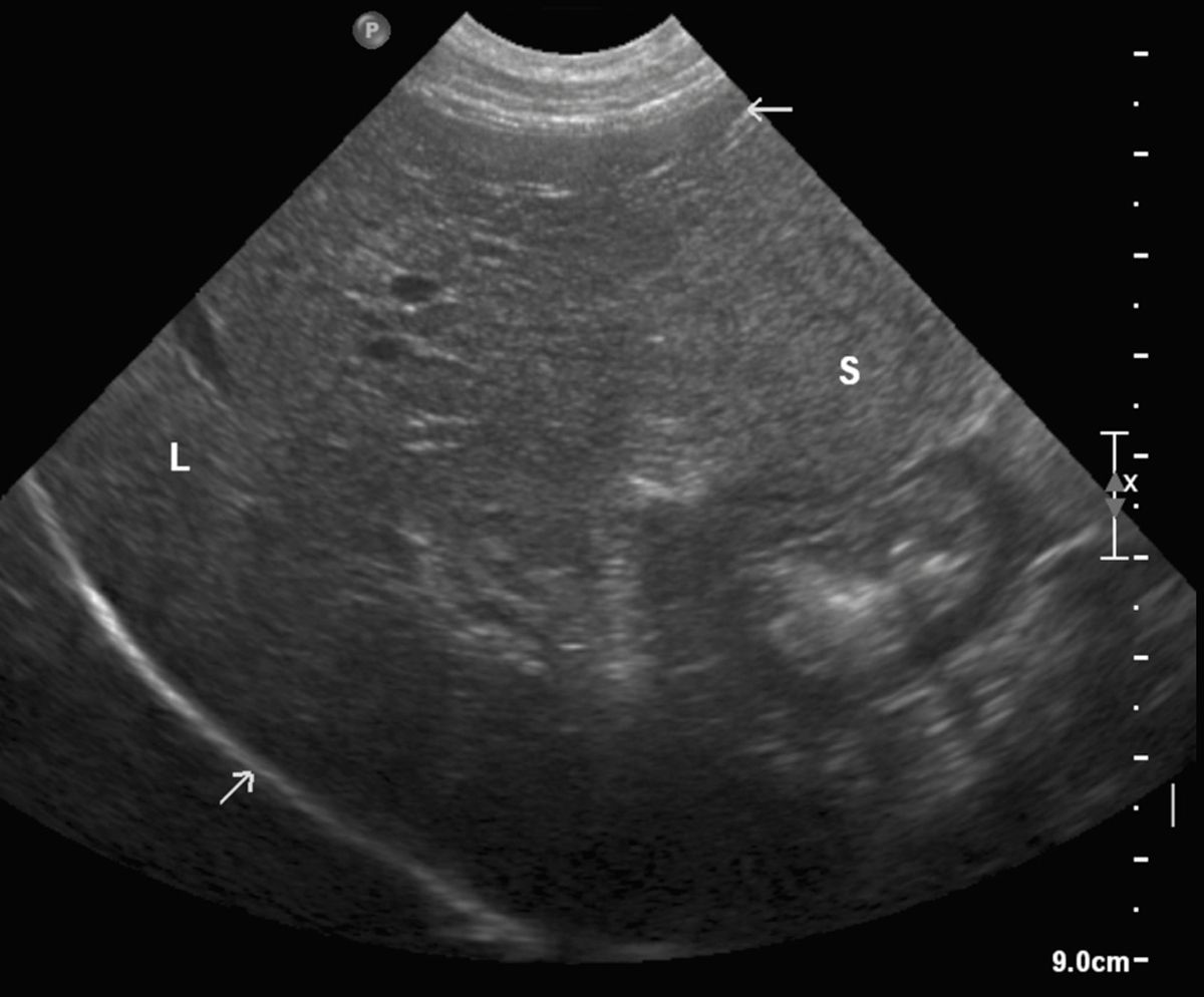 Ultraschall der normalen Leber eines Hundes. Linke Seite der Leber in der Sagittalebene; Die Leber hat ein homogenes Parenchym und ist hypoechogen zur Milz (S). Die Portalgefäße (weißer Pfeil) haben hyperechogene Wände.