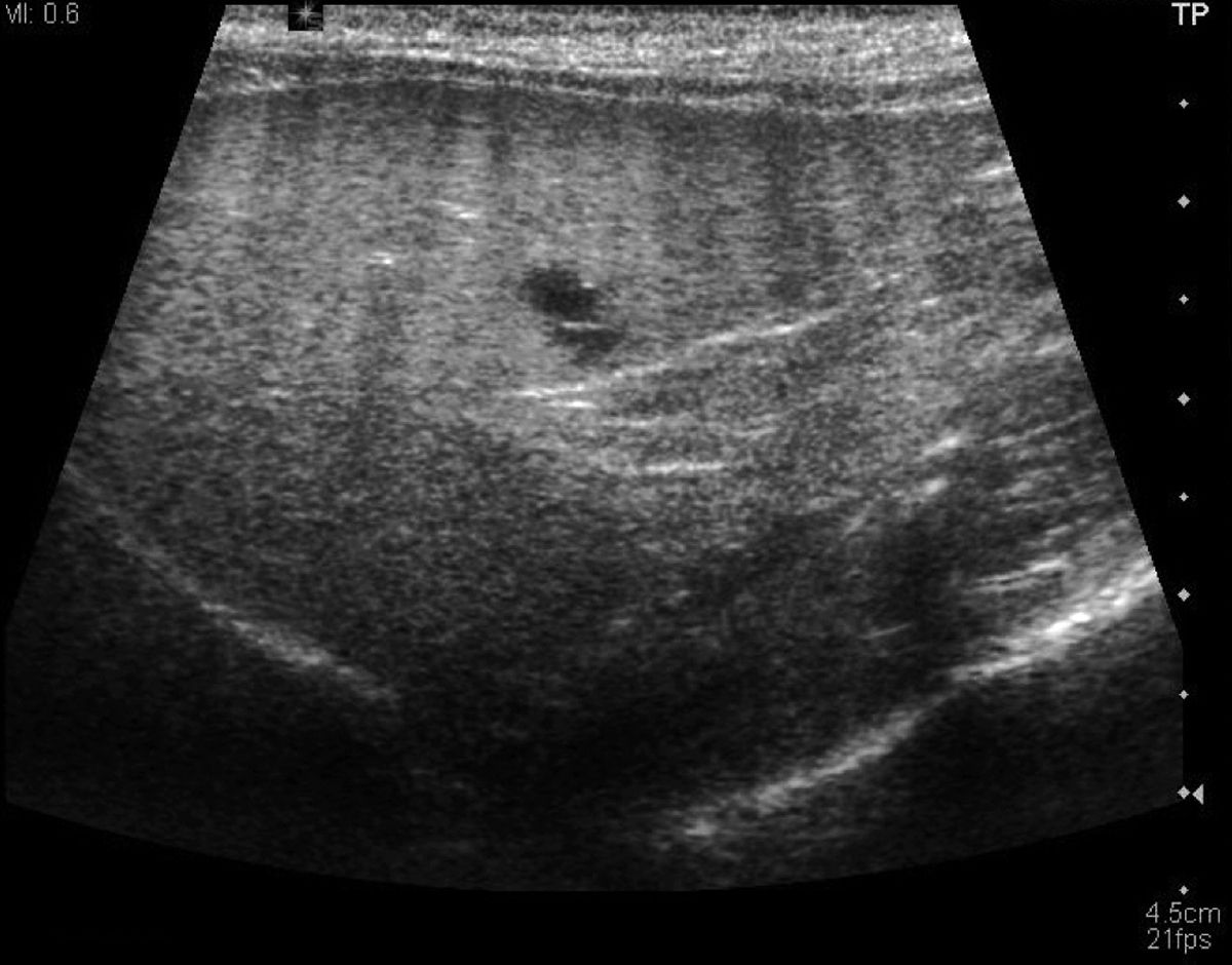 An ultrasound scan of a liver with hyperechoic parenchyma that is also hyperattenuating (reduced echogenicity in the deep field).