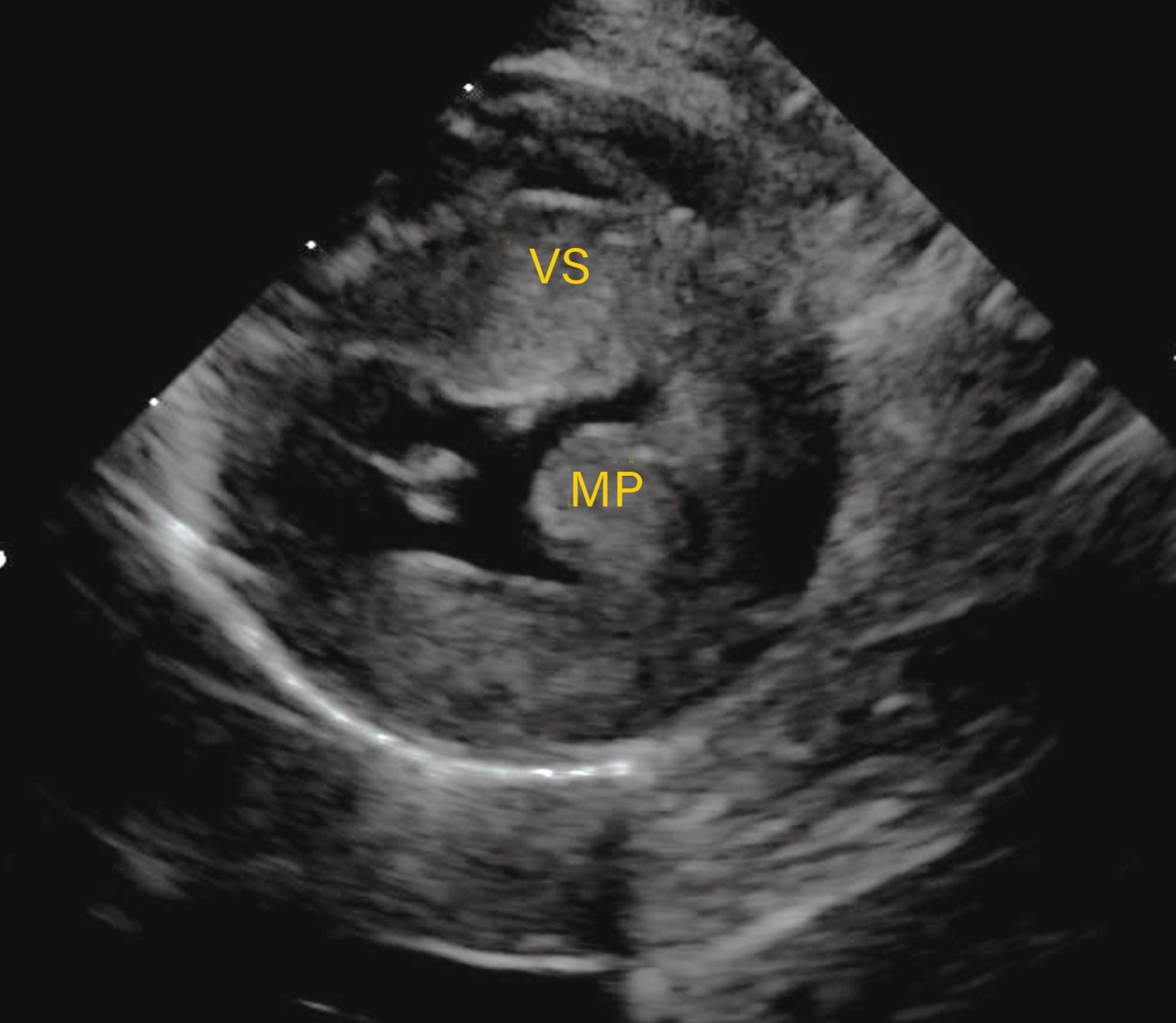 Observațiile ecocardiografice ale HCM pot să prezinte o mare variabilitate