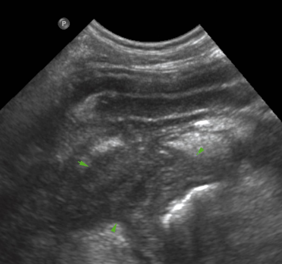 immagine ecografica in corso di pancreatite in un cane: il pancreas appare ispessito ed ipoecogeno (frecce verdi) ed è circondato da grasso, iperecogeno. La parete duodenale adiacente è ispessita.