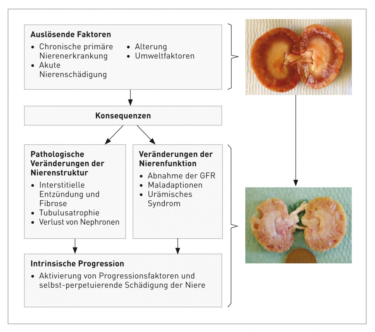 Allgemein anerkannter Mechanismus der Auslösung und des Fortschreitens der chronischen Nierenerkrankung. Auslösende Faktoren können „Konsequenzen“ haben: Veränderungen von Nierenstruktur und Nierenfunktion. Wenn die Erkrankung fortschreitet und es zu einem signifikanten Verlust funktioneller Nephronen kommt, tragen intrinsische maladaptive Antworten zu weiterer Nierenschädigung und zu einem weiteren Verlust von Nephronen bei. Die Fotos zeigen Querschnitte einer gesunden Niere (oben) und einer Niere mit CNE im Endstadium (unten). 