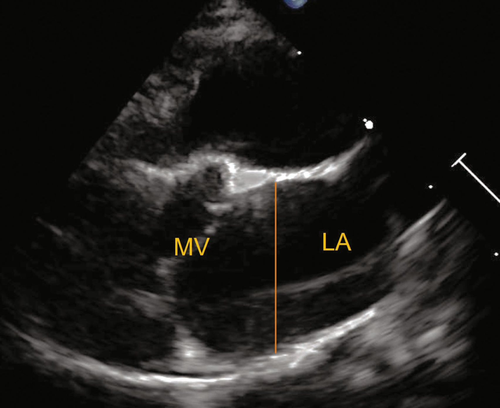 Cardiomyopathie hypertrophique féline au stade