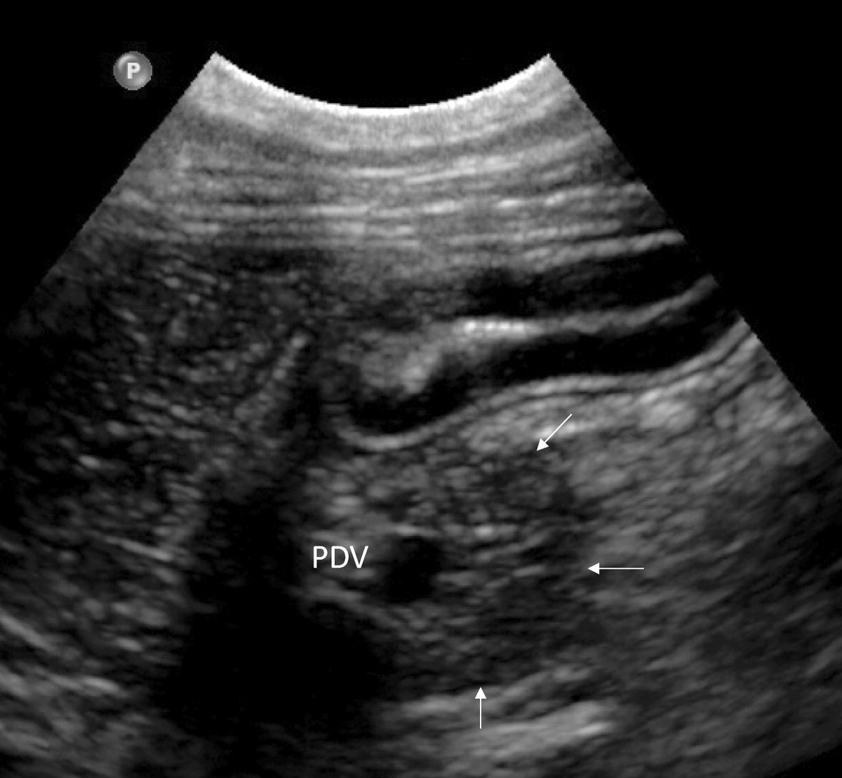 Ultraschall des normalen Pankreas (weiße Pfeile) bei einem Hund. Der Lobus pancreatis dexter verläuft entlang des Duodenums und kann durch Visualisierung der V. pancreaticoduodenalis (PDV) lokalisiert werden.