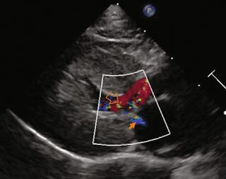 Murmurs in cats with HCM most often result from left ventricular outflow tract obstruction En los gatos con CMH, el soplo normalmente se debe a la obstrucción del tracto de salida del ventrículo izquierdo 