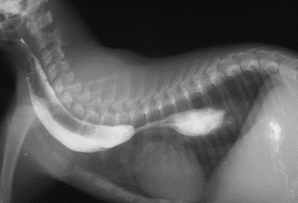 La radiografia toracica con mezzo di contrasto può essere utilizzata per diagnosticare una stenosi esofagea; si noti l’estrema dilatazione della porzione di esofago prossimale alla stenosi.