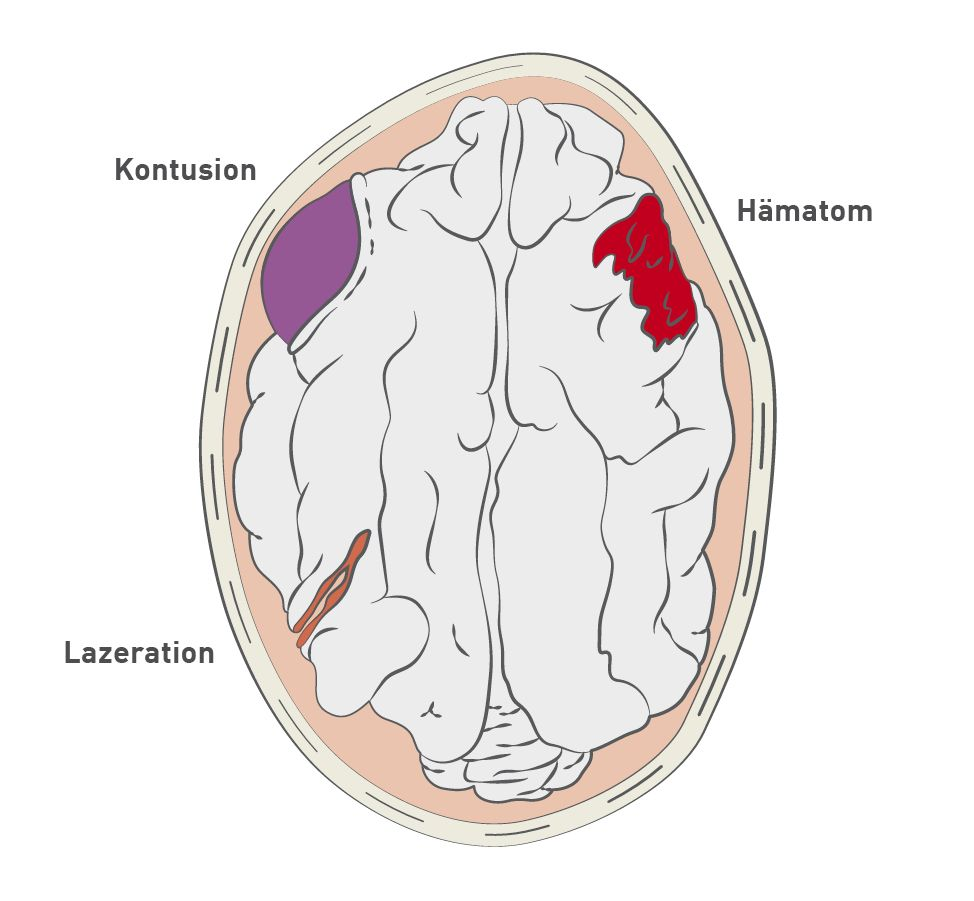 Schematische Darstellung ausgewählter primärer Hirnverletzungen