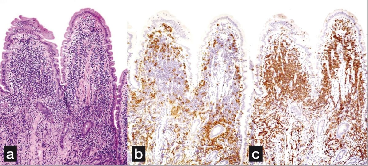 Histopathologische Befunde des Dünndarms einer Katze mit IBD. (a) Die Mucosa des Dünndarms weist eine diffuse lymphoplasmazelluläre Infiltration auf (H&E Färbung). (b) Einige Entzündungszellen färben sich positiv für CD20 an, einen Marker für B-Zellen. (c) Einige Entzündungszellen färben sich positiv für CD3 an, einen Marker für T-Zellen. 