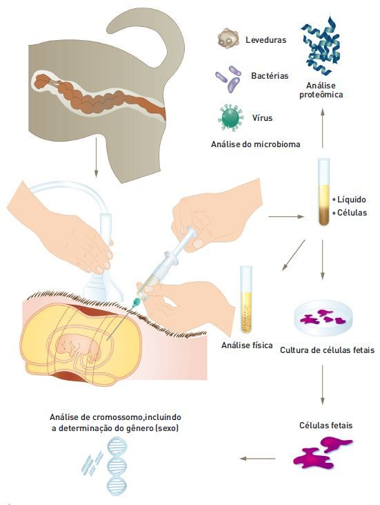 Figura 3. A centese de líquidos fetais se presta a várias aplicações de diagnóstico e pesquisa, incluindo a análise de agentes microbianos, a caracterização genética, a cultura de células fetais e a análise física do líquido.  Créditos: Redesenhado por Sandrine Fontègne