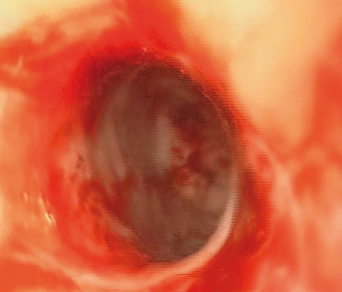 Exploración endoscópica del Caso 2. Después de la dilatación se observó la presencia de importantes úlceras multifocales.