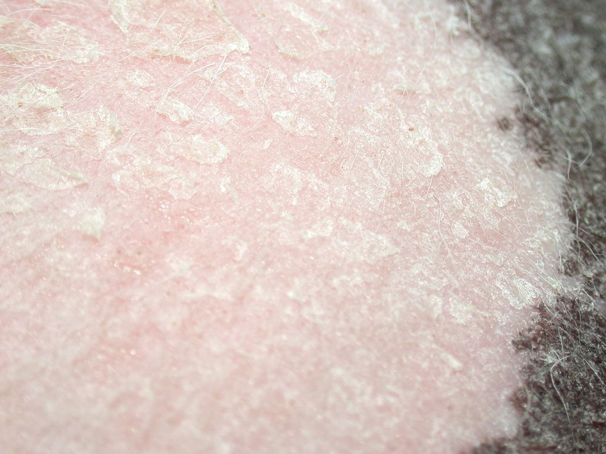 Figure 5. Dermatite exfoliative féline avec de grandes plages de squames sur la peau et une légère érythrodermie généralisée.© Patricia D. White