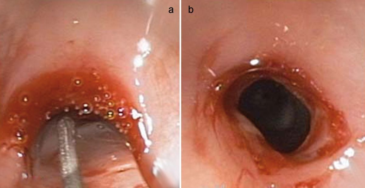 La stenosi durante (a) e dopo (b) la dilatazione con catetere a palloncino; si noti il diametro del lume dopo il trattamento rispetto a quello mostrato nella Figura R1-2a.