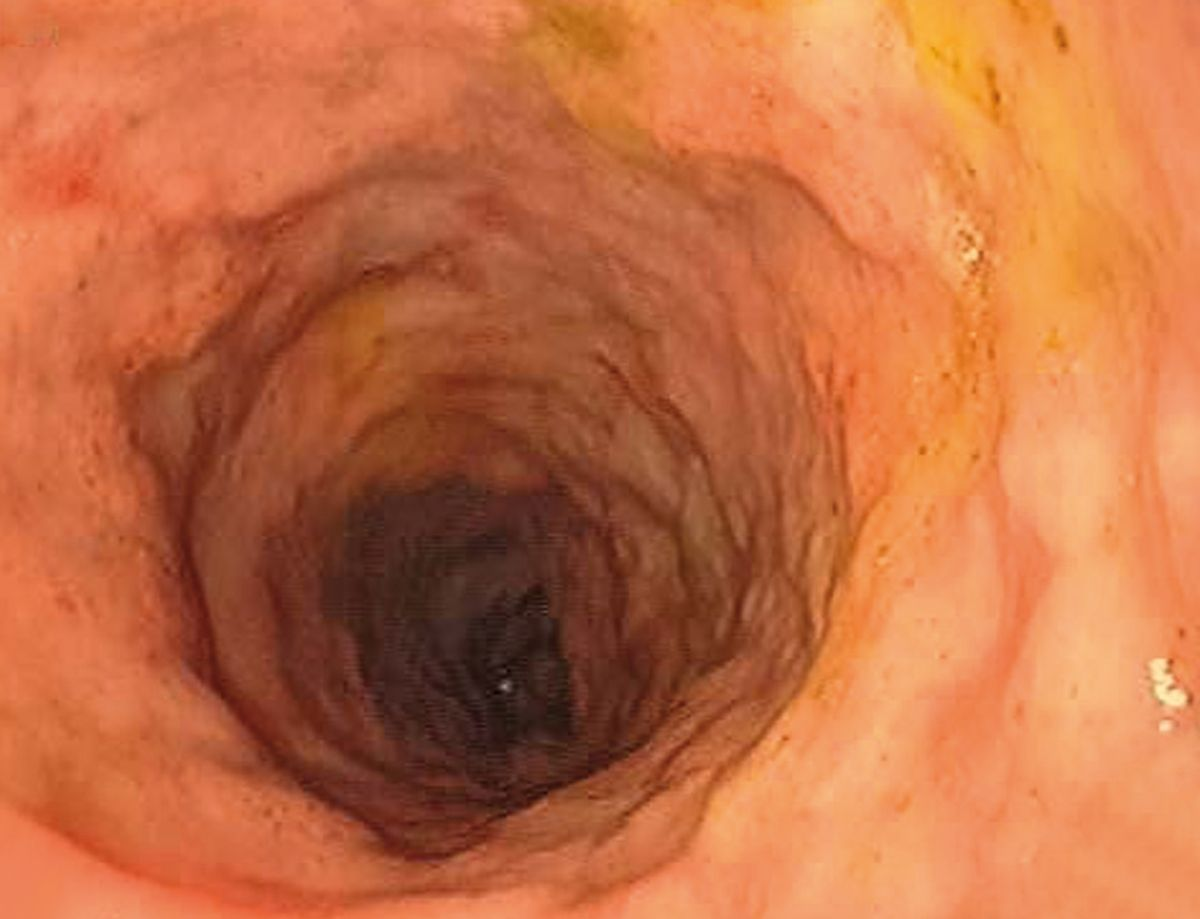 Colonoscopia del Caso 5. Nótese la apariencia irregular de la mucosa y la deficiente visualización de los vasos, sugiriendo una inflamación o neoplasia.