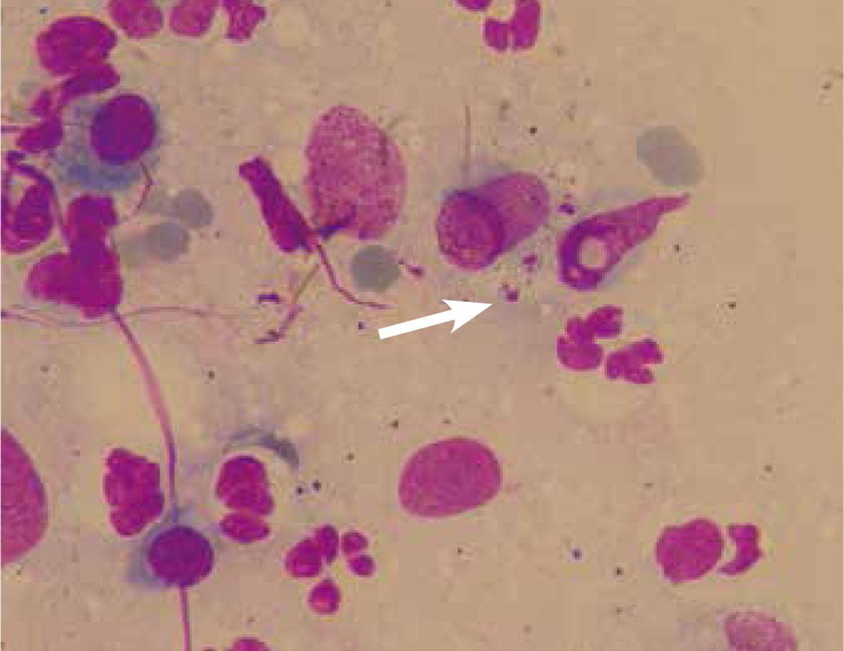 Intralesional Leishmania parasites (arrowed) can be demonstrated by cytology.