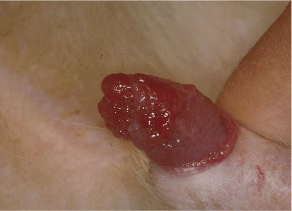 Mucocutaneous nodular lesions at the tip of the penis.