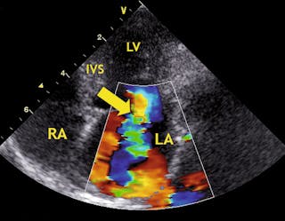 LA: left atrium, LV: left ventricle