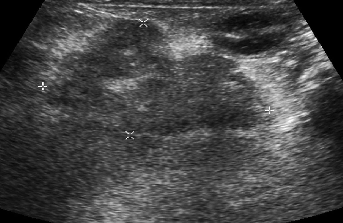 Abdominal ultrasound image showing an enlarged, hypoechoic, feline pancreas with hyperechoic surrounding mesentery, consistent with pancreatitis.