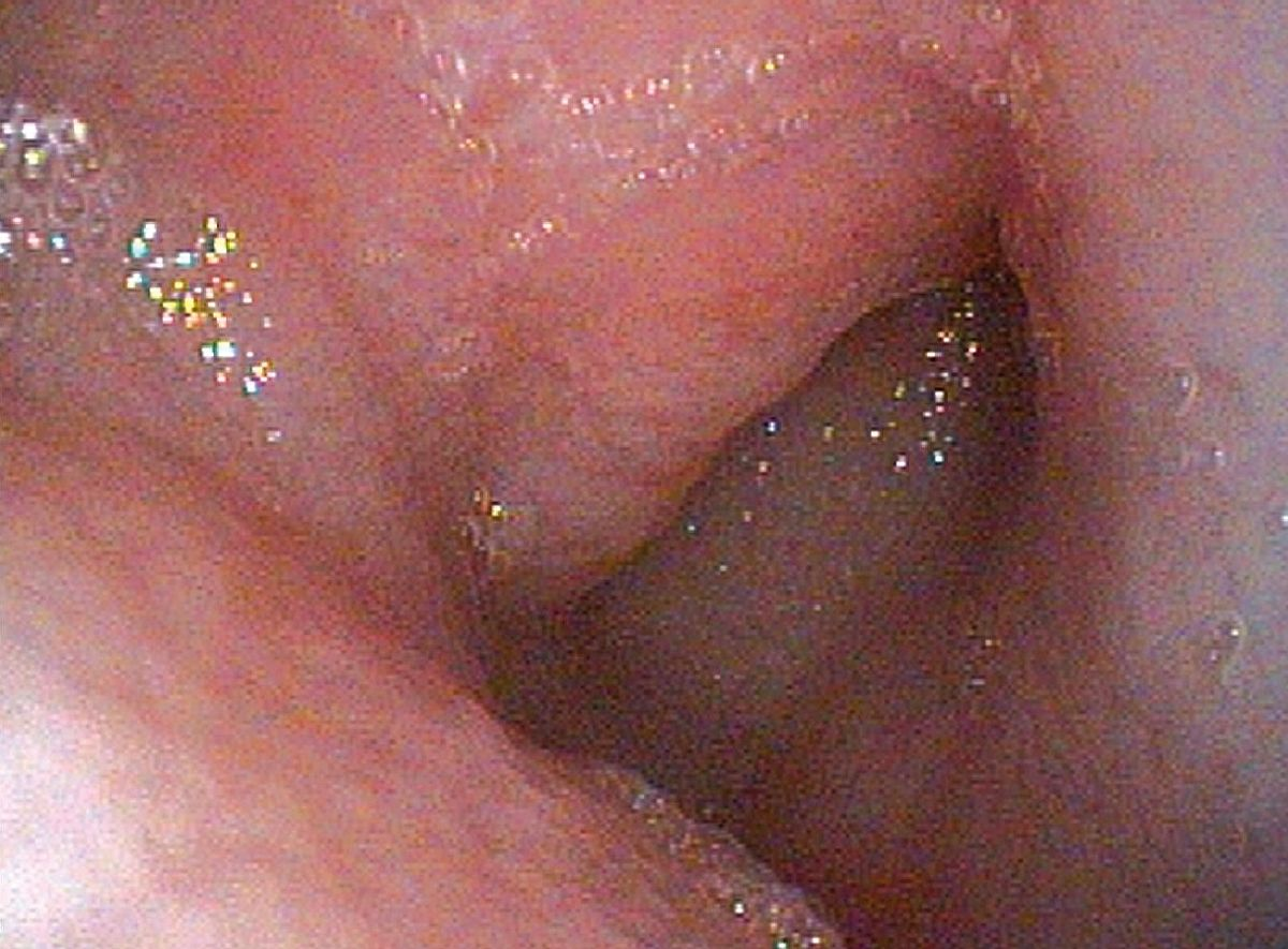 Endoscopic view of the feline duodenum; histopathology revealed moderate lymphocyticplasmacytic inflammatory bowel disease.