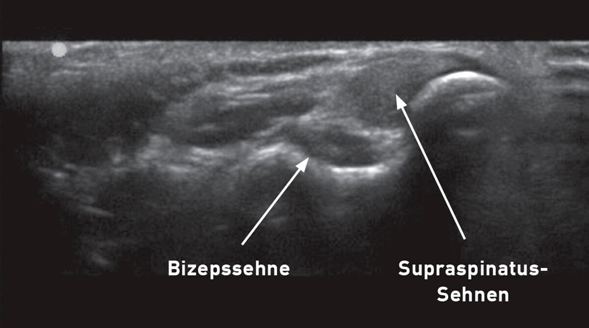 Ein umfassendes Screening kann den frühzeitigen Nachweis von Verletzungen bei Arbeitshunden unterstützen, zum Beispiel mit Hilfe der hier dargestellten muskuloskelettalen Sonographie der Schultergliedmaße eines Hundes, die das normale Erscheinungsbild der Bizeps- und Supraspinatussehnen zeigt. 