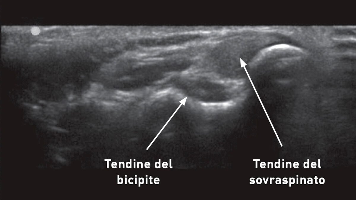 Uno screening completo può contribuire a identificare precocemente lesioni in animali da lavoro; ad esempio, questa ecografia muscoloscheletrica dell'arto anteriore di un cane mostra l'aspetto normale dei tendini del bicipite e del sovraspinato.