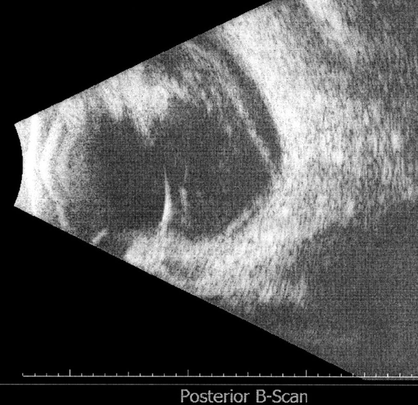 Figure 10. Echographie oculaire en mode B révélant 