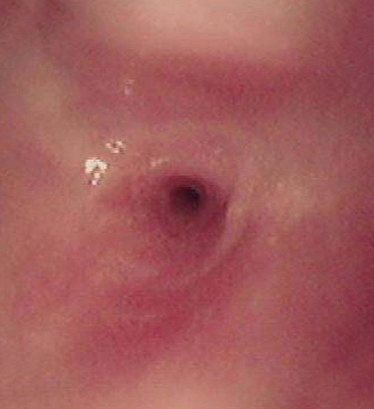 Sténose oesophagienne secondaire, à l’endoscopie.