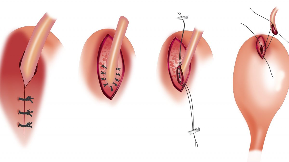 Urolithiase de l’appareil urinaire supérieur 