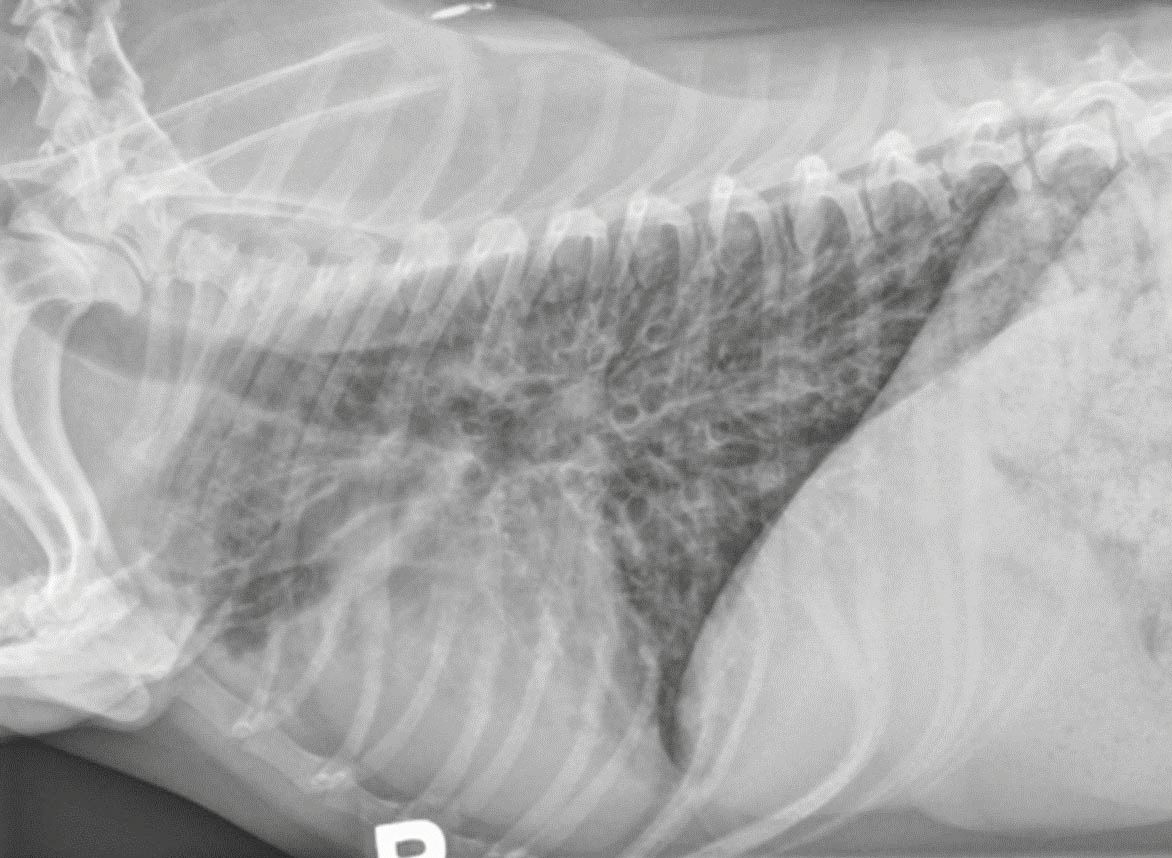 Cette radiographie thoracique latérale droite montre une bronchectasie sévère