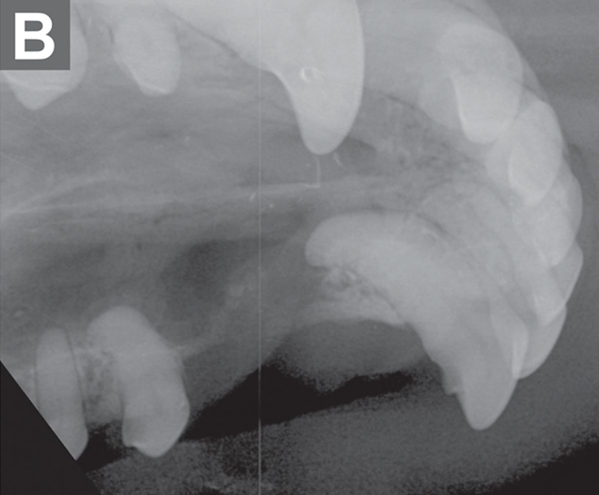 Diese intraorale Zahnröntgenaufnahme (rechtslaterale Caninusaufnahme, Halbwinkeltechnik) bestätigt den fehlenden rechten maxillären Caninus und einen umgebenden scharf abgrenzbaren Knochenverlust in der Region der Turbinalia, einhergehend mit einer oronasalen Fistel. 