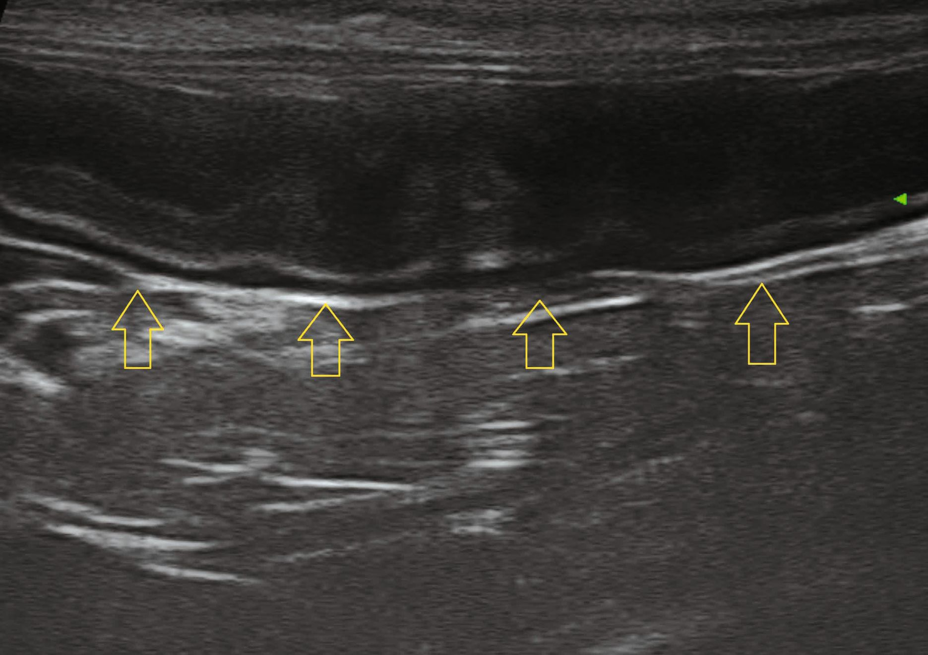 Image échographique d’un segment de l’intestin grêle chez un chat adulte présentant des vomissements et une diarrhée d’apparition aiguë, avec un diagnostic de pancréatite