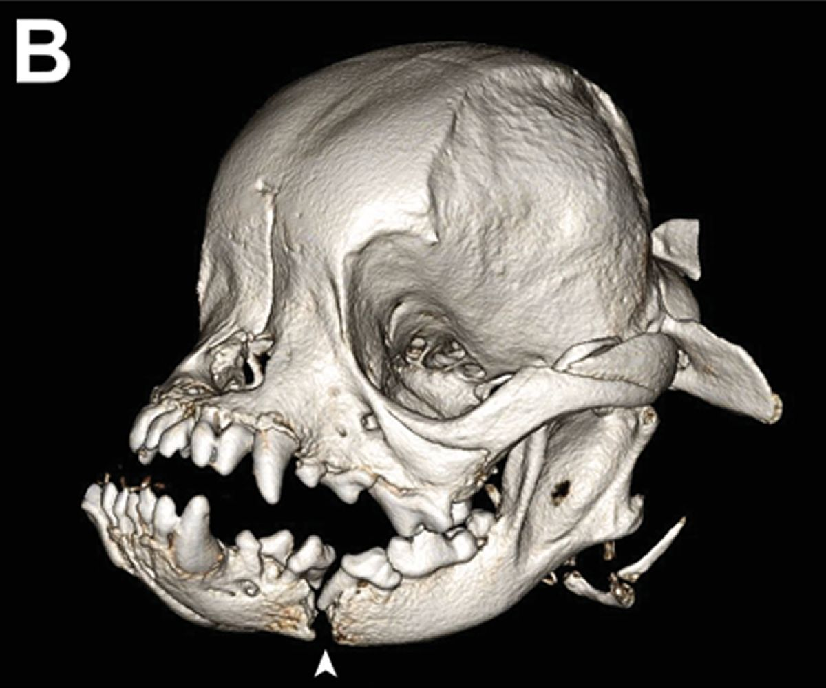 Three-dimensional reconstruction using cone-beam computed tomography provided more detailed information about the fracture (arrowhead). 