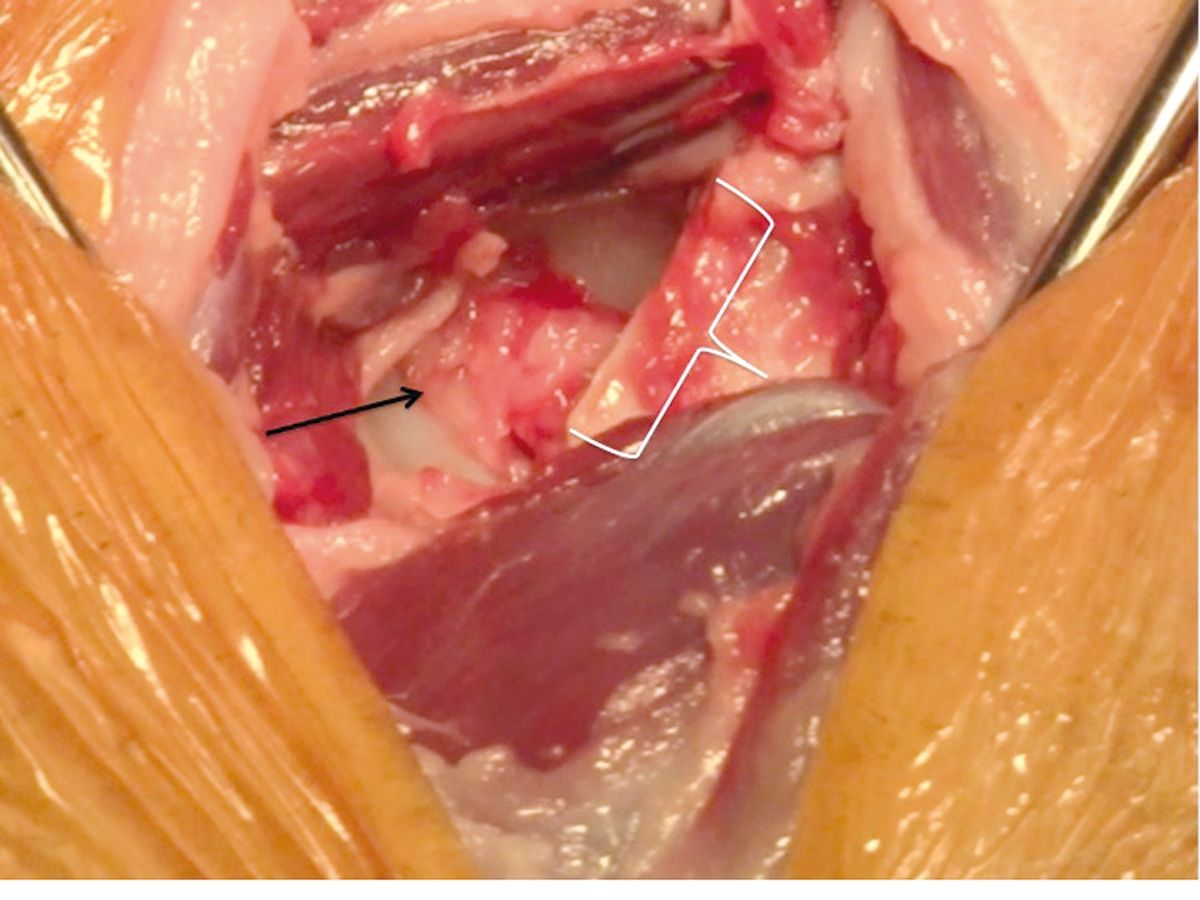 Escisión de la cabeza y cuello del fémur. La flecha negra señala la región del acetábulo craneal (el área blanca debajo de la flecha es el cartílago articular del acetábulo. La punta de la flecha se encuentra sobre lo que queda del ligamento de la cabeza femoral). El corchete señala al fémur una vez realizada la osteotomía y eliminados la cabeza y cuello del fémur. La osteotomía abarca desde el aspecto medial del trocánter mayor al trocánter menor.