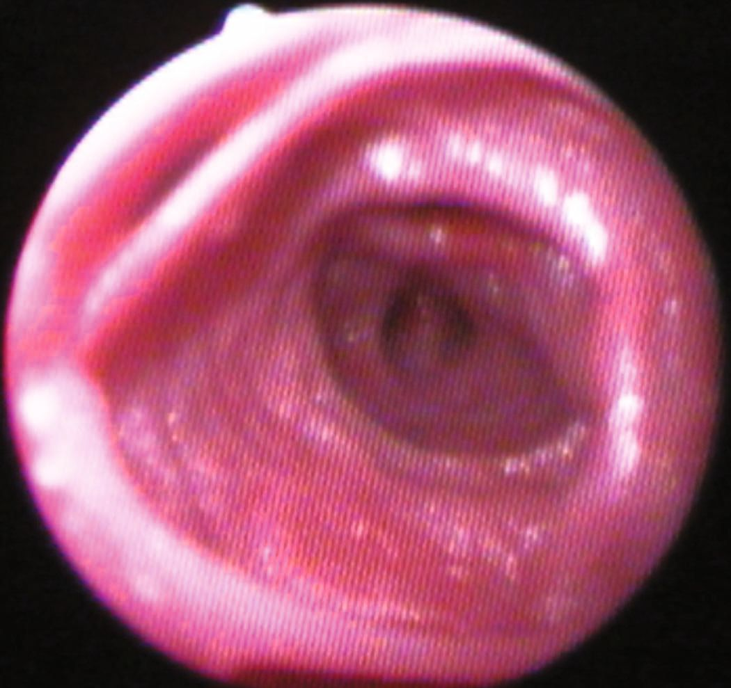Cette image bronchoscopique illustre une bronchectasie marquée avec hyperémie